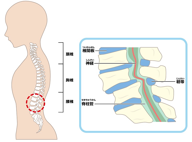 腰部脊柱管狭窄症