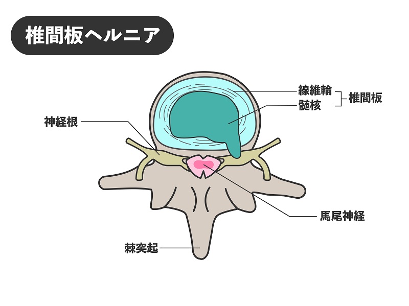 腰椎椎間板ヘルニア