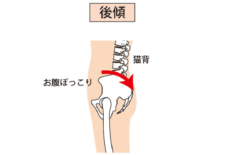 骨盤の後傾